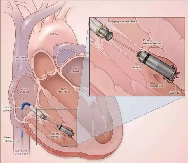 全國首批！遼西首例！葫蘆島市第二人民醫(yī)院心臟中心完成遼西首例Micra AV無導(dǎo)線起搏器植入術(shù)(圖2)