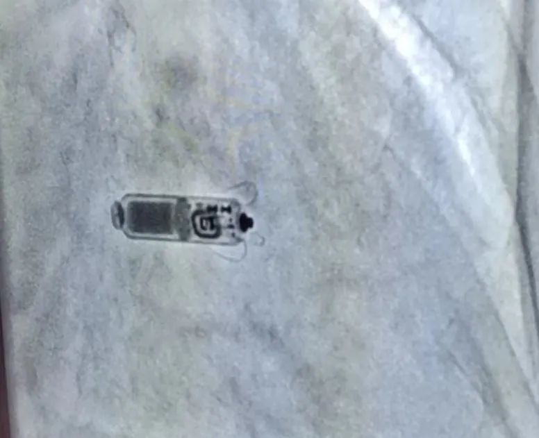 全國首批！遼西首例！葫蘆島市第二人民醫(yī)院心臟中心完成遼西首例Micra AV無導(dǎo)線起搏器植入術(shù)(圖4)