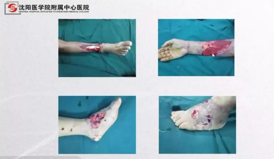 聚焦顯微外科|葫蘆島市醫(yī)學(xué)會(huì)顯微外科學(xué)分會(huì)第一屆第二次學(xué)術(shù)會(huì)議順利召開(圖8) 聚焦顯微外科|葫蘆島市醫(yī)學(xué)會(huì)顯微外科學(xué)分會(huì)第一屆第二次學(xué)術(shù)會(huì)議順利召開(圖8)