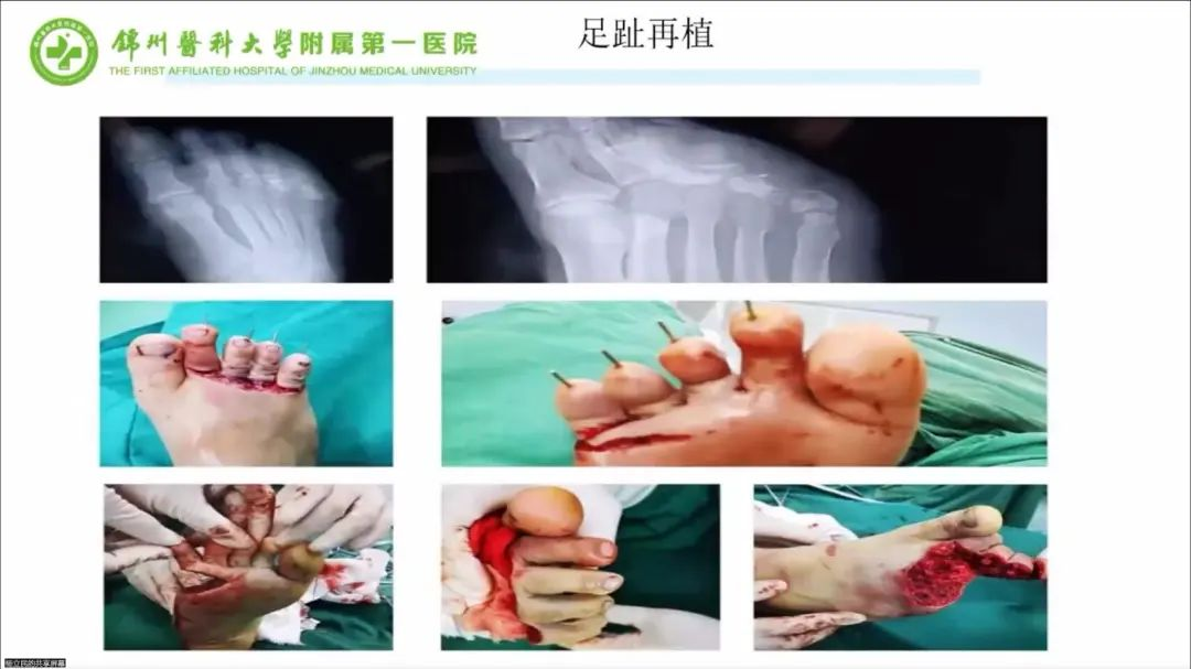 聚焦顯微外科|葫蘆島市醫(yī)學(xué)會(huì)顯微外科學(xué)分會(huì)第一屆第二次學(xué)術(shù)會(huì)議順利召開(圖16) 聚焦顯微外科|葫蘆島市醫(yī)學(xué)會(huì)顯微外科學(xué)分會(huì)第一屆第二次學(xué)術(shù)會(huì)議順利召開(圖16)