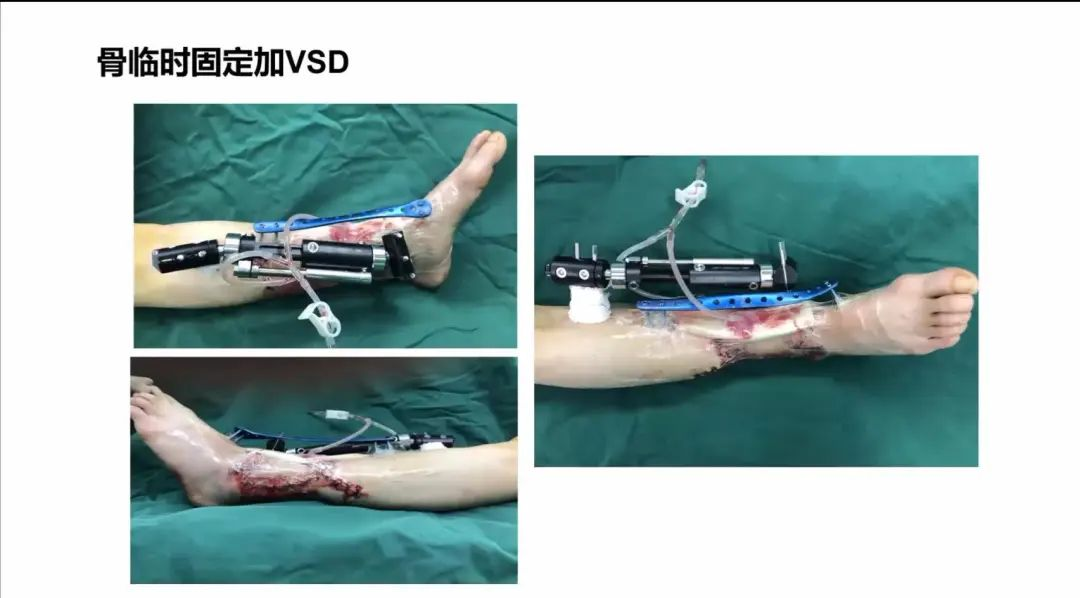 聚焦顯微外科|葫蘆島市醫(yī)學(xué)會(huì)顯微外科學(xué)分會(huì)第一屆第二次學(xué)術(shù)會(huì)議順利召開(圖22) 聚焦顯微外科|葫蘆島市醫(yī)學(xué)會(huì)顯微外科學(xué)分會(huì)第一屆第二次學(xué)術(shù)會(huì)議順利召開(圖22)